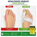 Corrector Nocturno de Juanetes PROFOOT